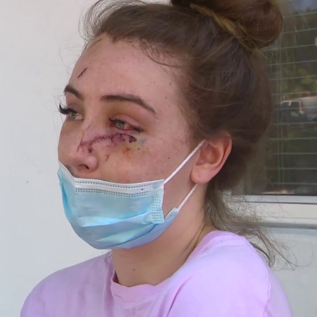 Woman recovering after brutal, unprovoked beating at the hands of neighbor